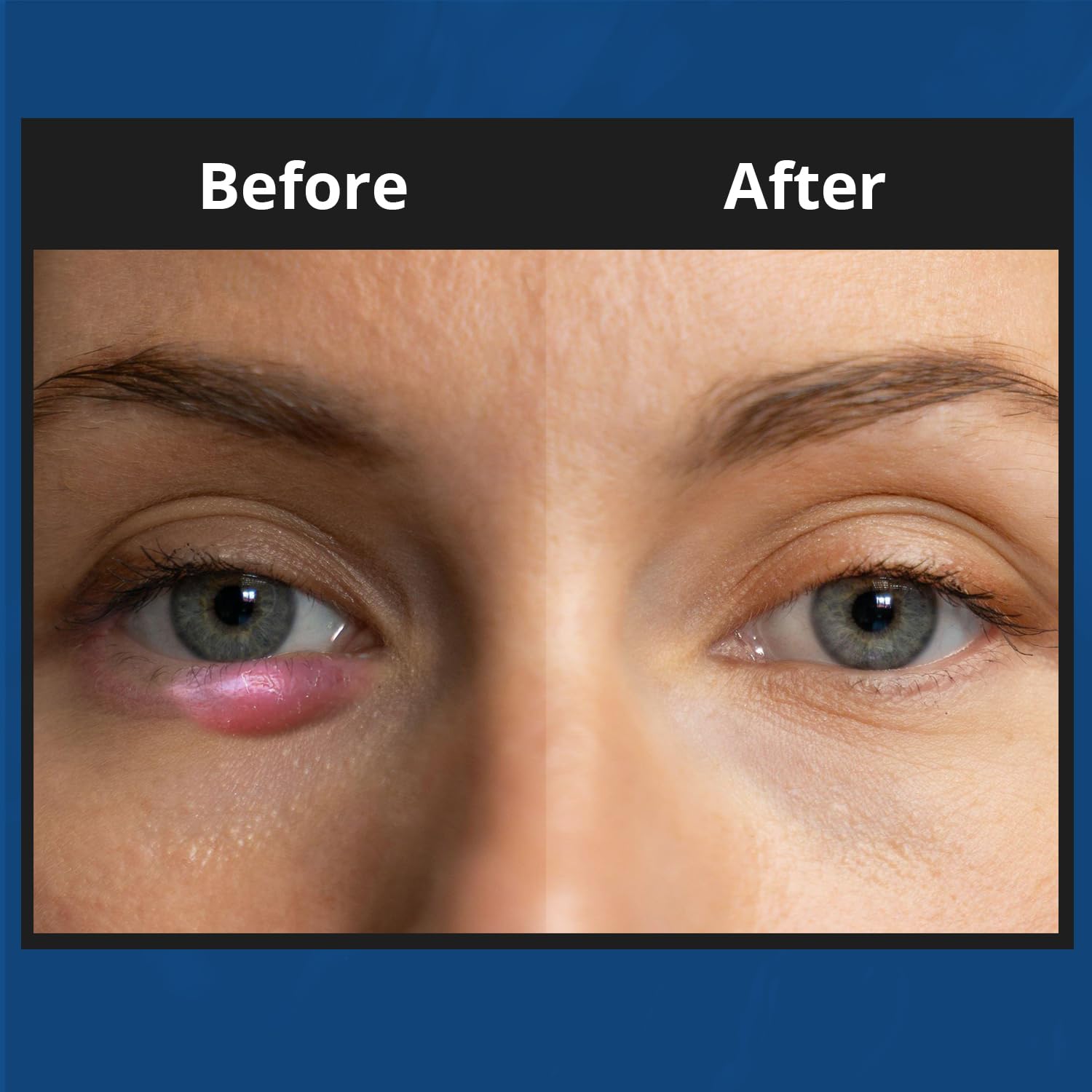 NOVEHA XStye application on eyelid area for daily hygiene