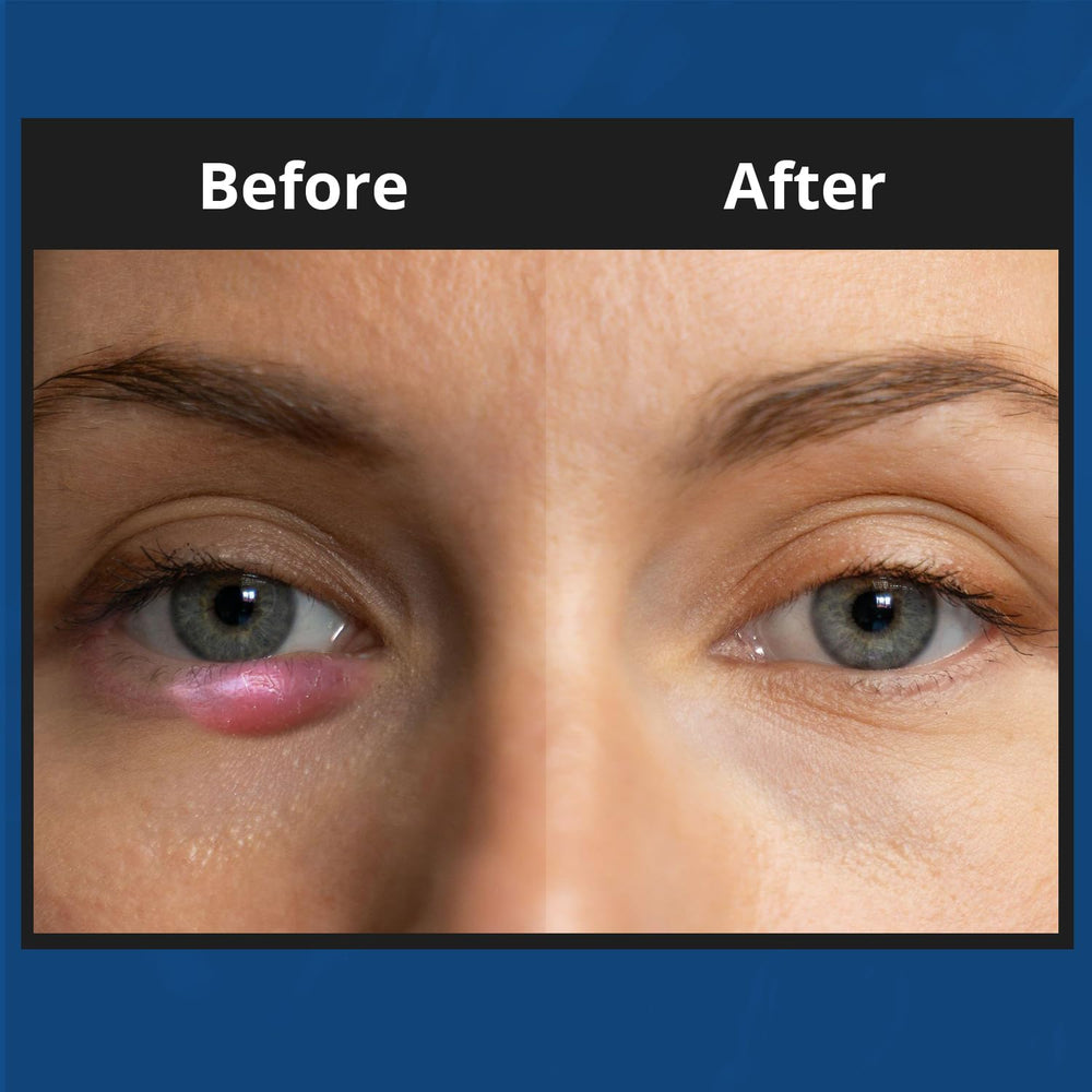 NOVEHA XStye application on eyelid area for daily hygiene