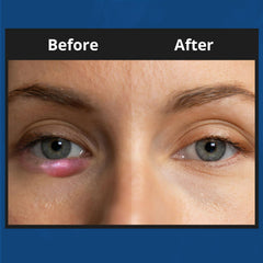 NOVEHA XStye application on eyelid area for daily hygiene
