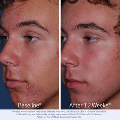 Obagi CLENZIderm Daily Care foaming cleanser targets oil-prone skin for a balanced look.