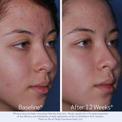 Obagi toner applied with cotton pad for gentle exfoliation.