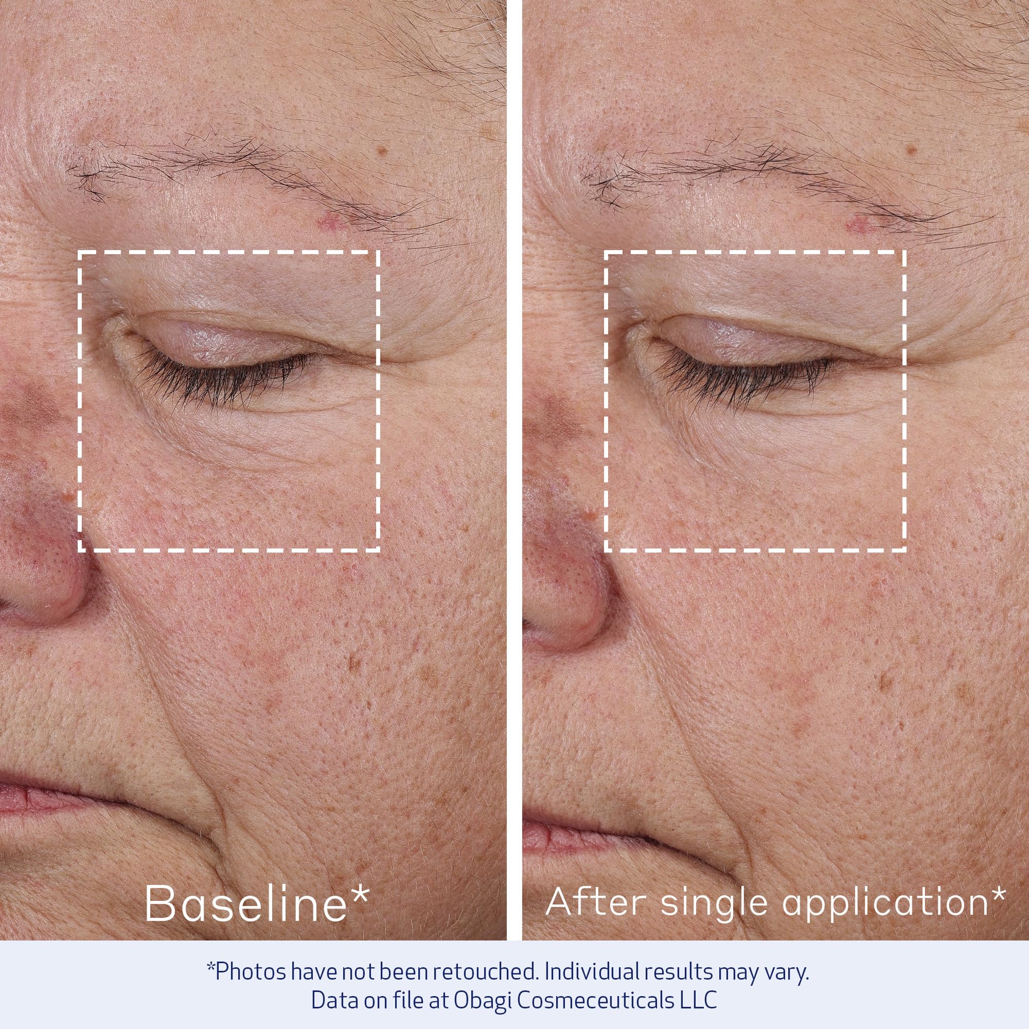 Obagi ELASTIderm Advanced Filler application closeup shows smooth application.