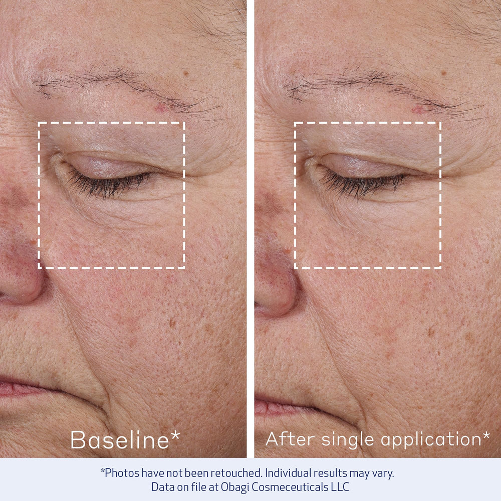Obagi ELASTIderm Advanced Filler application closeup shows smooth application.