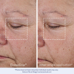 Obagi ELASTIderm Advanced Filler application closeup shows smooth application.