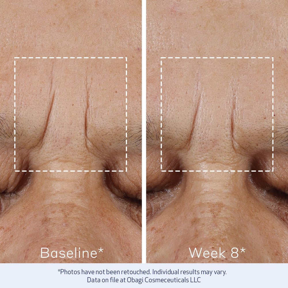 Obagi ELASTIderm Advanced Filler clinical-result image suggests blurred-lines improvement.