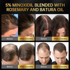 OCSINL Minoxidil massage tip reaching roots supports thorough scalp coverage