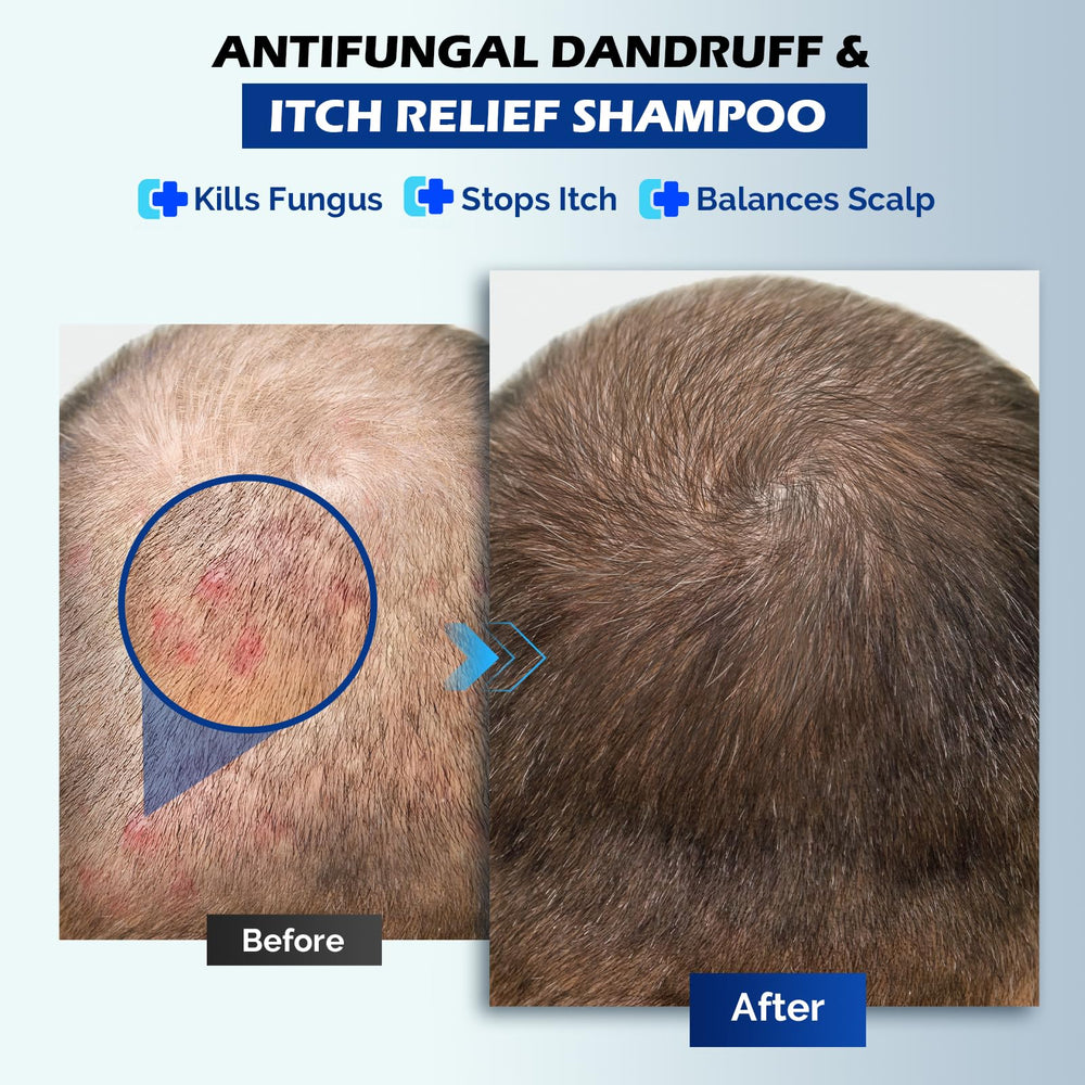oely antifungal shampoo hair-wash scene illustrates gentle cleansing for damaged scalps