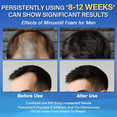 Olassubd Minoxidil five-percent foam being applied to thinning crown area for targeted care.