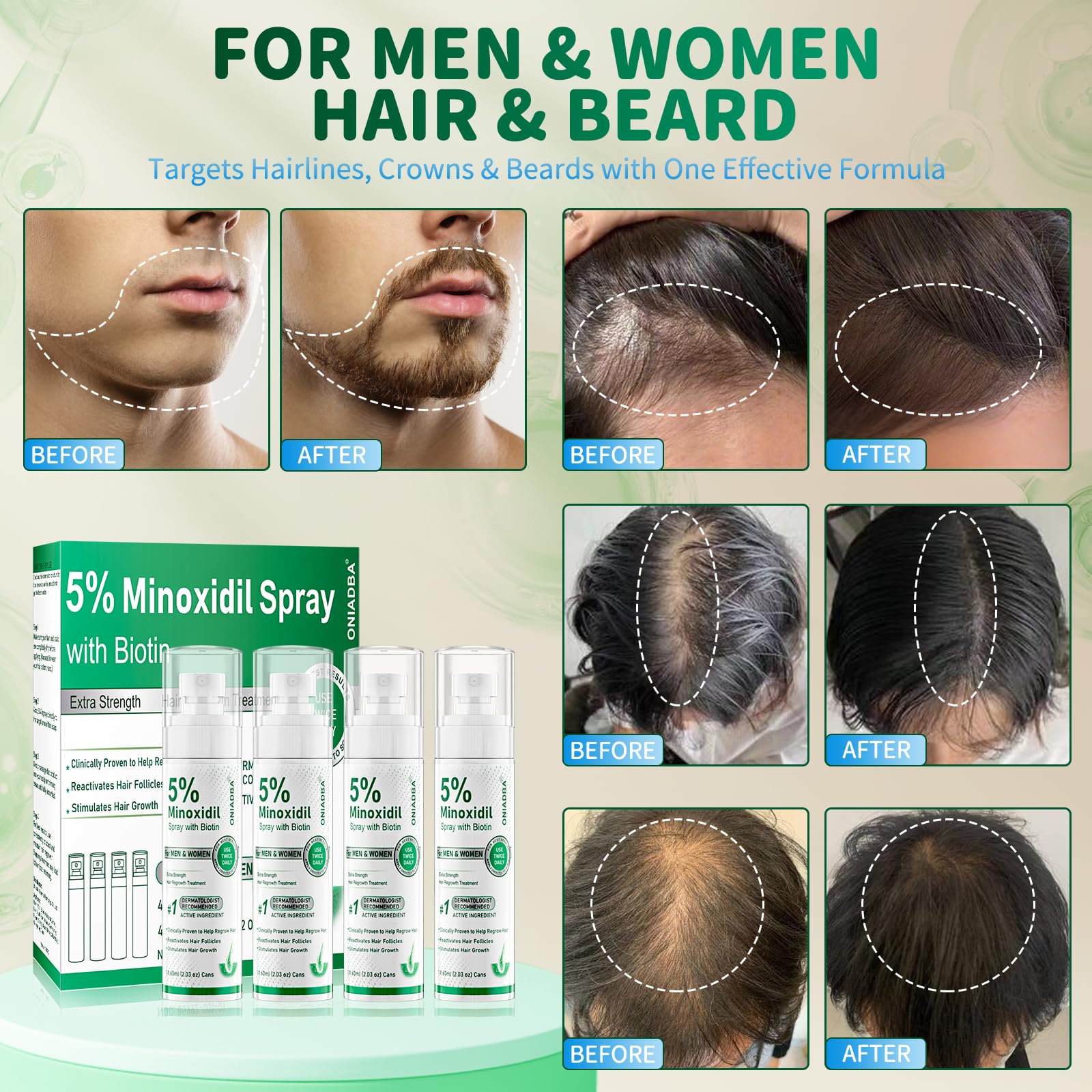 ONIADBA minoxidil spray applied to scalp to promote follicle stimulation.