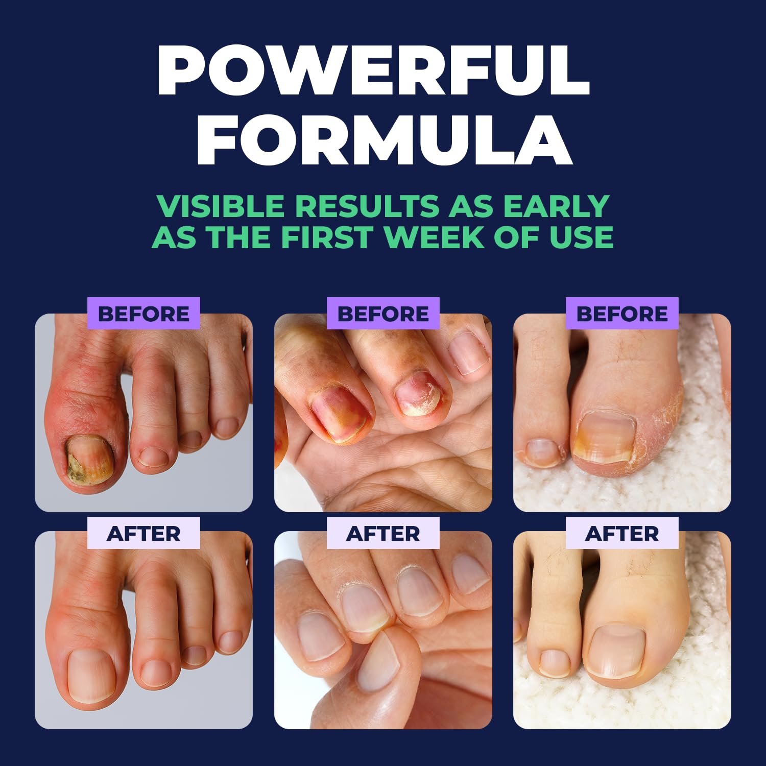 Orivelle Nail Fungus Pen daily use visual emphasizing gentle, routine care.