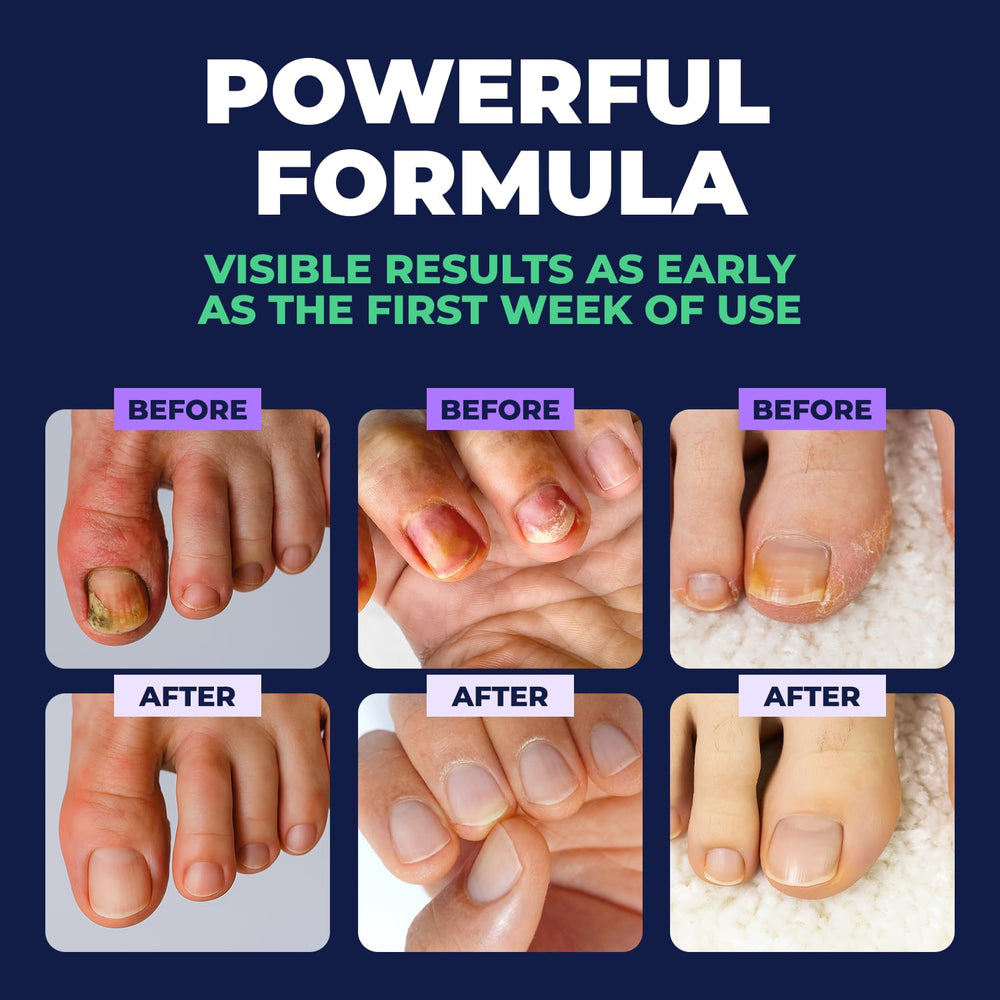 Orivelle Nail Fungus Pen daily use visual emphasizing gentle, routine care.