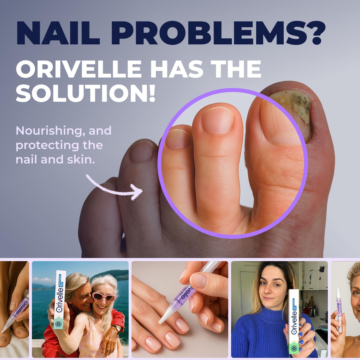 Orivelle Nail Fungus Pen close-up illustrating improved nail appearance.