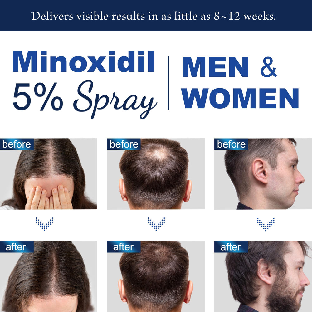 OSIMOON minoxidil bottle close-up shows biotin and collagen ingredients for scalp nourishment.