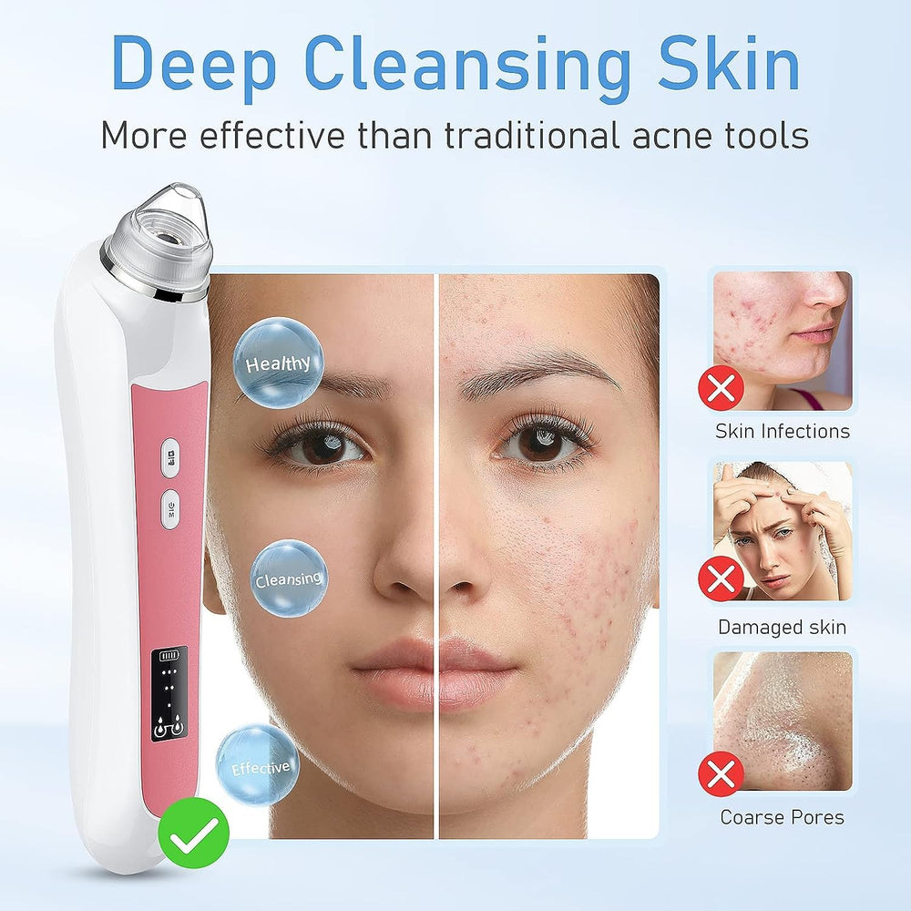 Ottleba Blackhead Remover Vacuum with LED lighting improves visibility during pore cleaning.