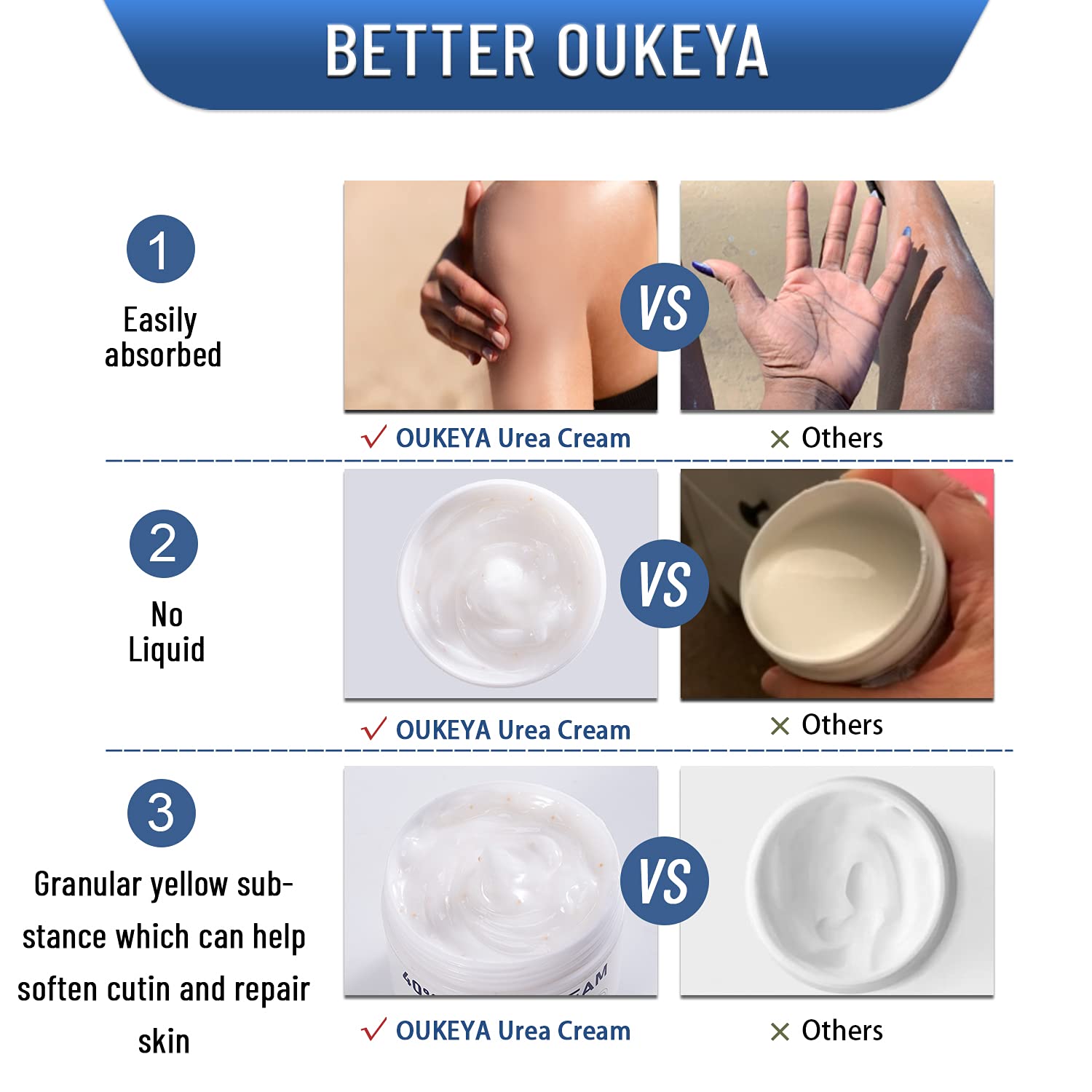 OUKEYA Urea Cream 40% applied to dry elbows for softer skin.