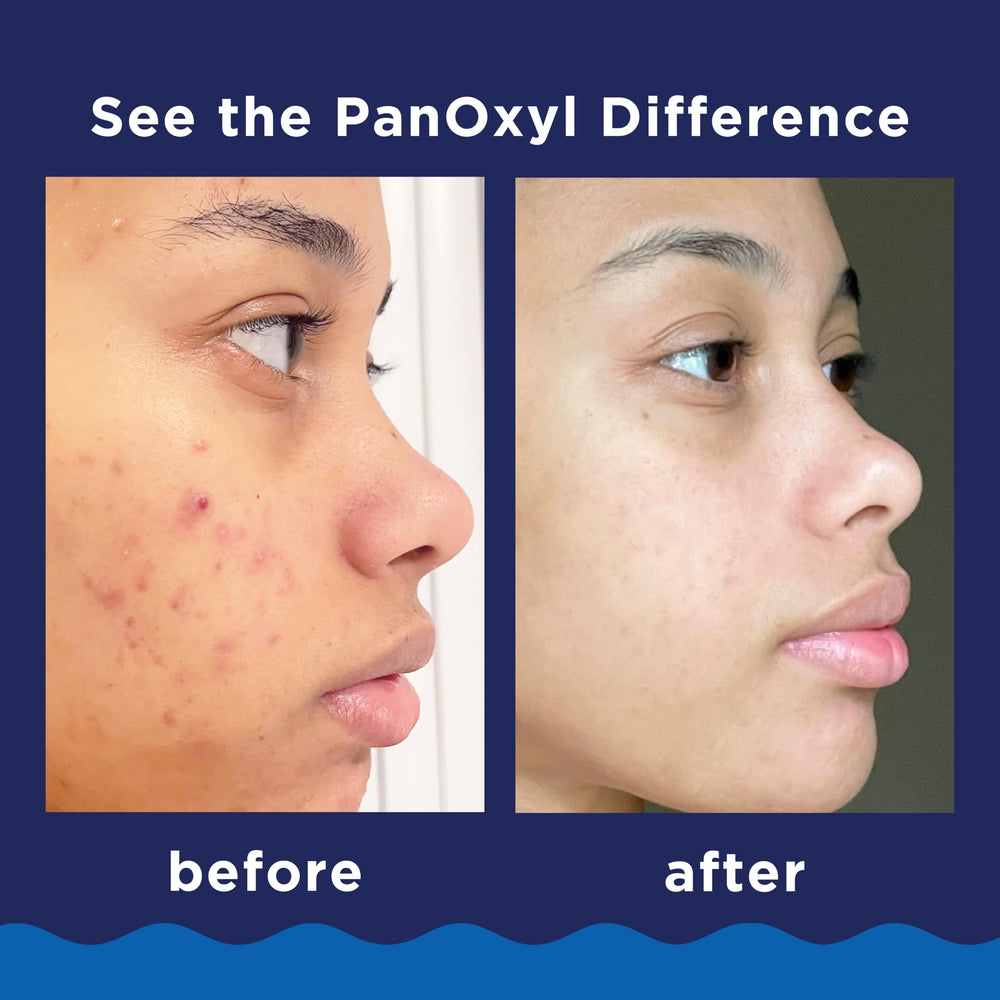 Using PanOxyl on back and chest to treat body breakouts effectively