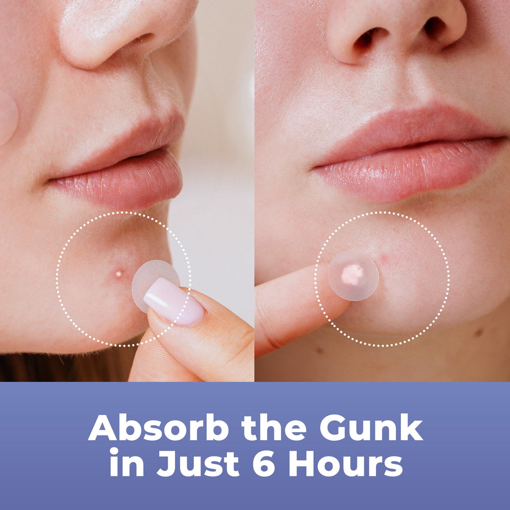 PatchRx hydrocolloid patches absorbing fluids from a blemish