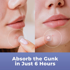 PatchRx hydrocolloid patches absorbing fluids from a blemish
