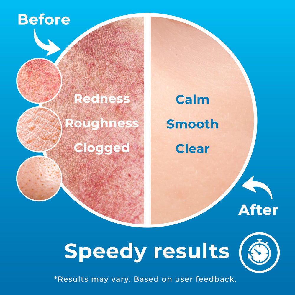 PatchRx HOCL spray for eczema flare-ups on irritated skin.