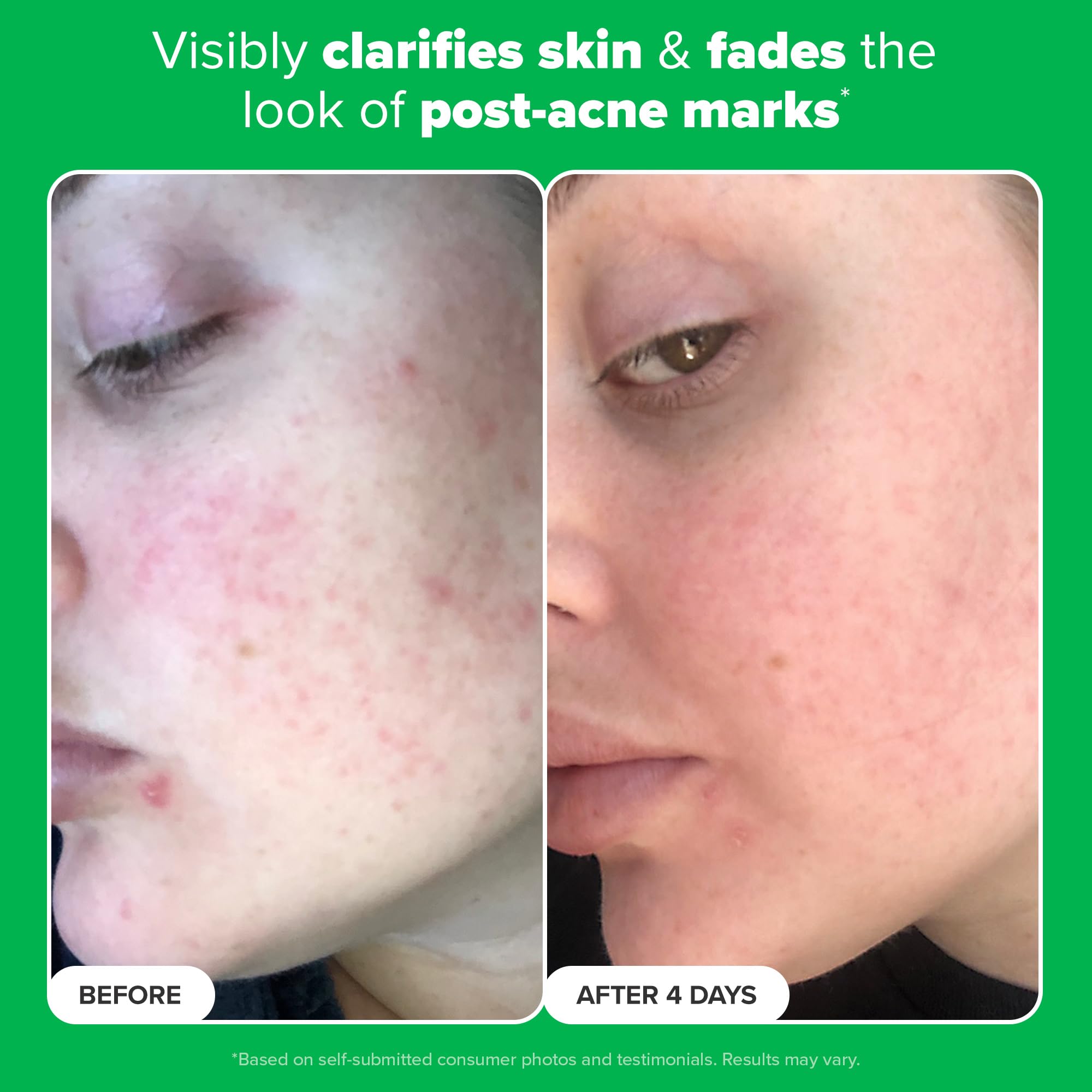 Paula's Choice BOOST azelaic acid application routine with moisturizer pairing.
