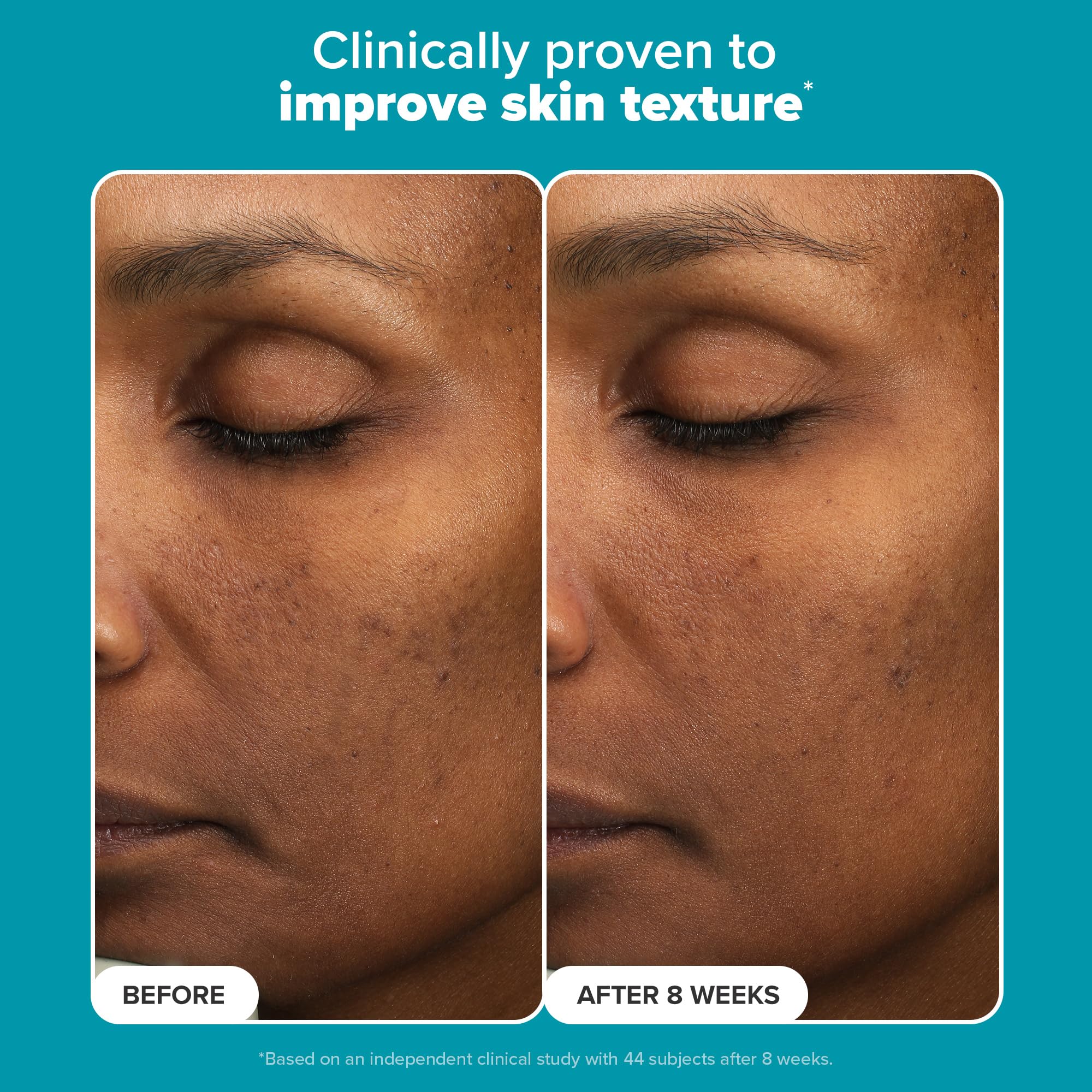Paula's Choice exfoliant on skin demonstrates glow and smoother texture