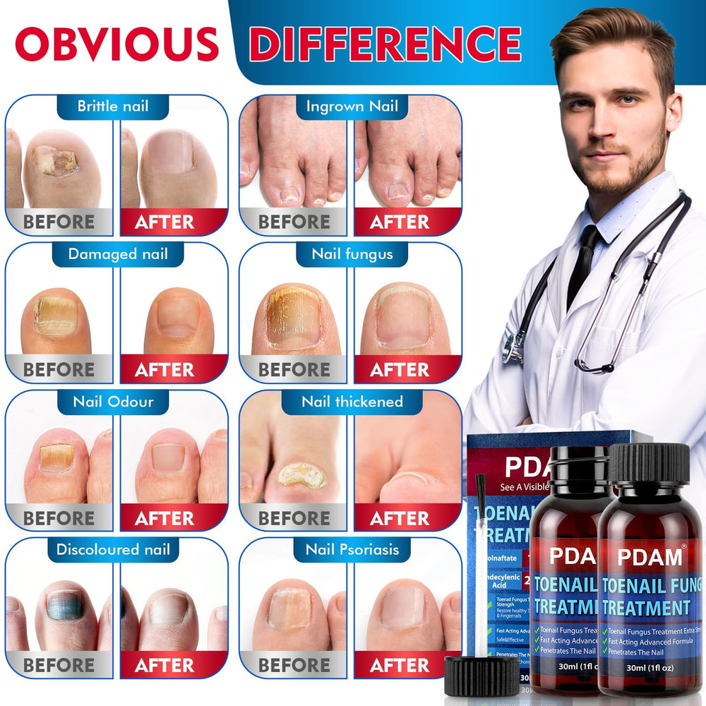 PDAM foot-nail treatment area close-up—deep penetration reaches nail surface and surrounding skin.