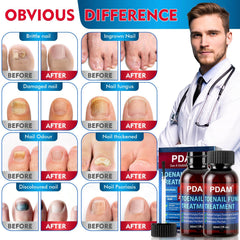 PDAM foot-nail treatment area close-up—deep penetration reaches nail surface and surrounding skin.