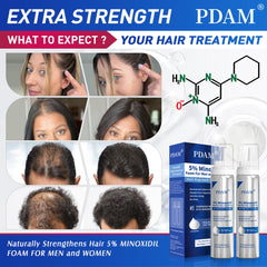 Pdam Minoxidil foam beard-growth showing thicker facial hair over time.