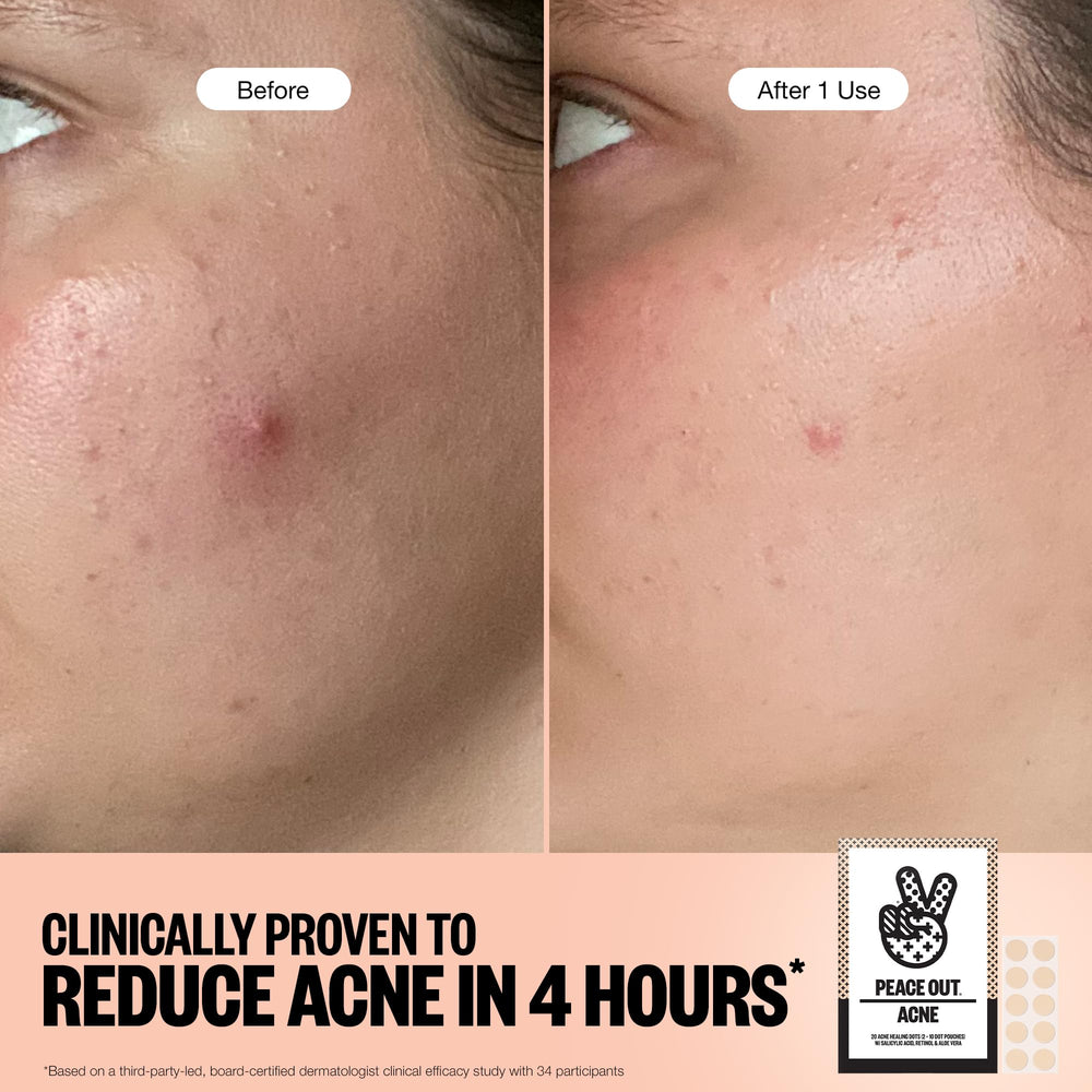 PEACE OUT Acne Healing Dots suited for sensitive skin and sensitive users.