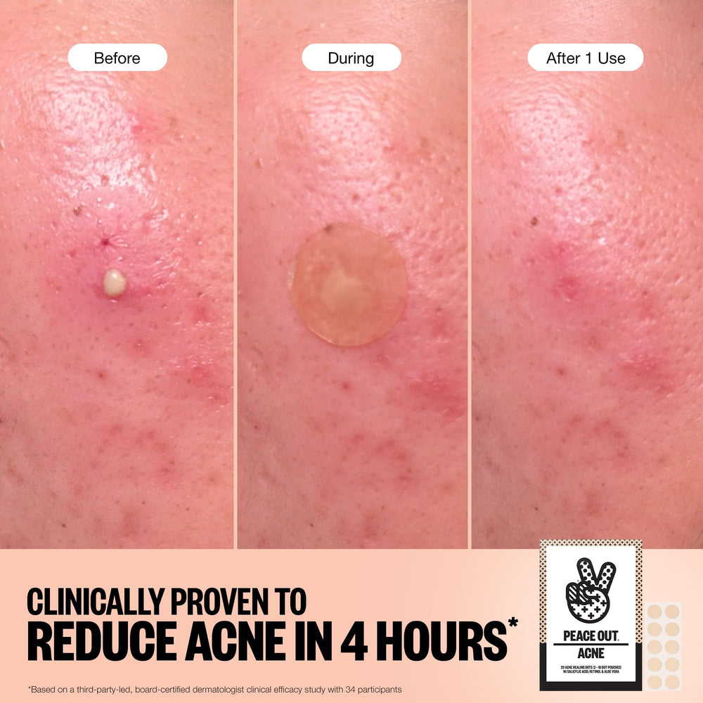 PEACE OUT Acne Healing Dots on-face at night demonstrates overnight blemish support.