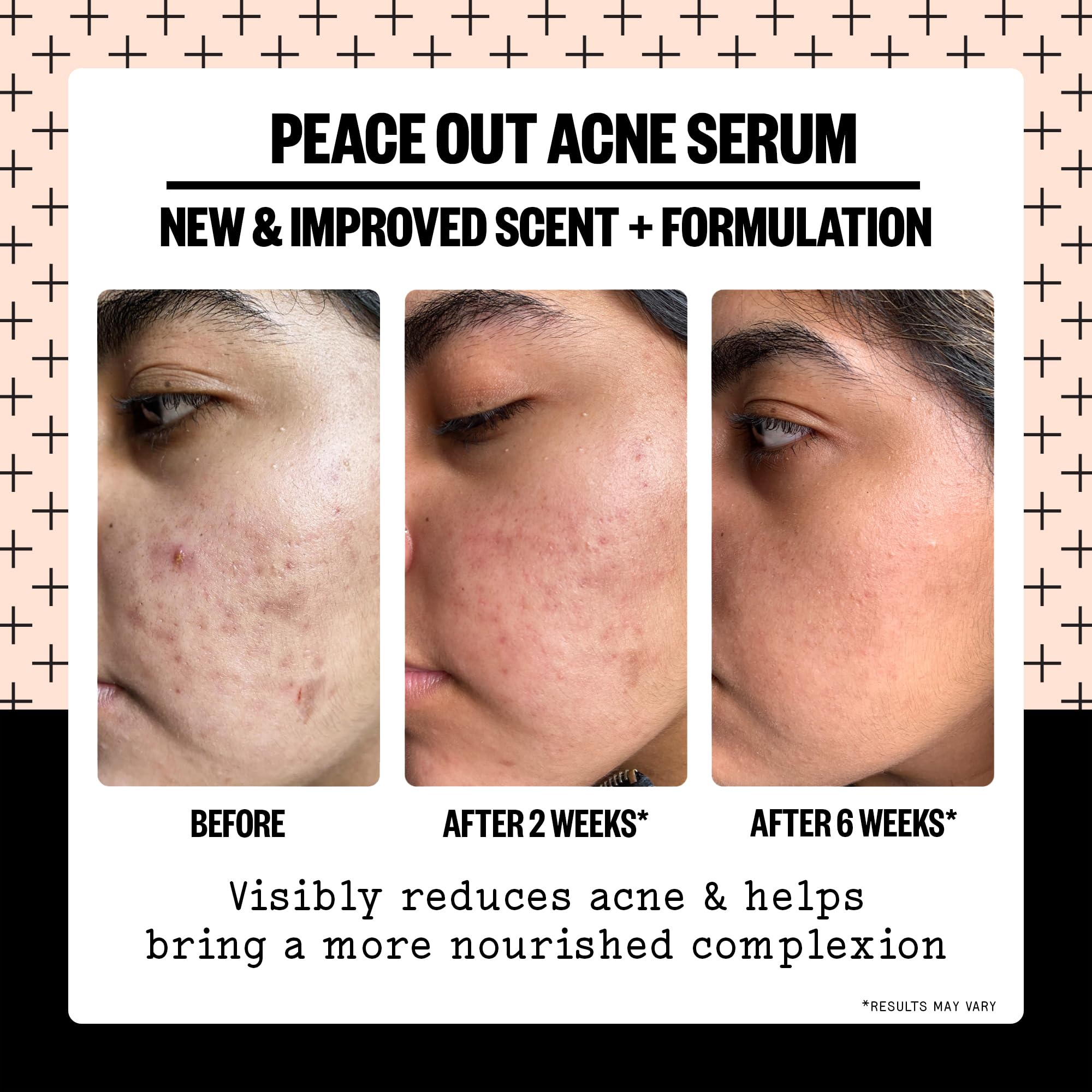 Peace Out Acne Serum spot-treatment view focusing on pimples and redness reduction potential