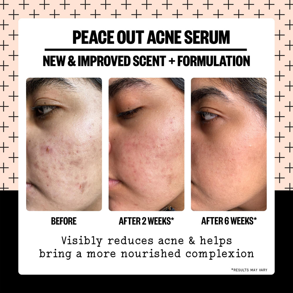 Peace Out Acne Serum spot-treatment view focusing on pimples and redness reduction potential