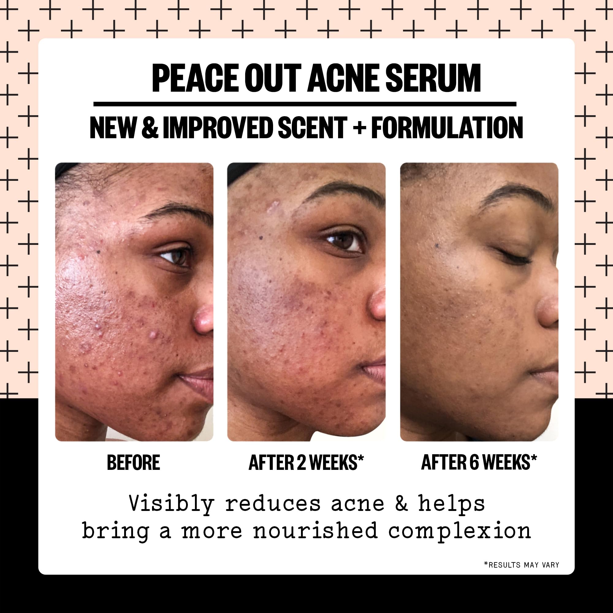 Peace Out Acne Serum swirls on skin showing lightweight, non-greasy hydration