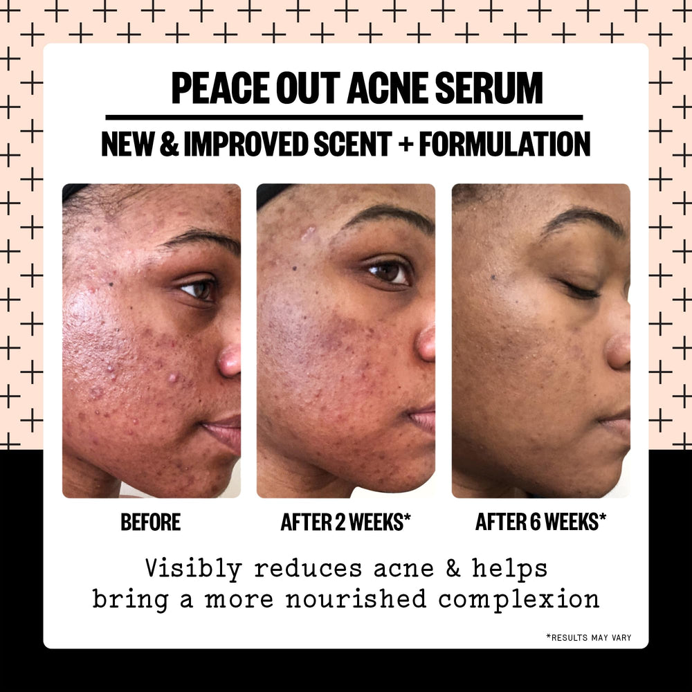 Peace Out Acne Serum swirls on skin showing lightweight, non-greasy hydration