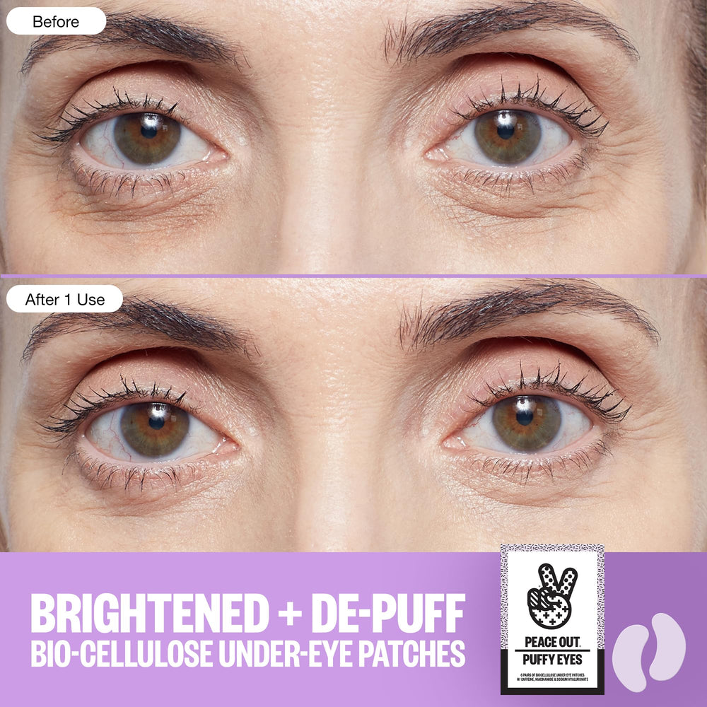 Peace Out Puffy Eyes patches placed on the eye area to help de-puff.