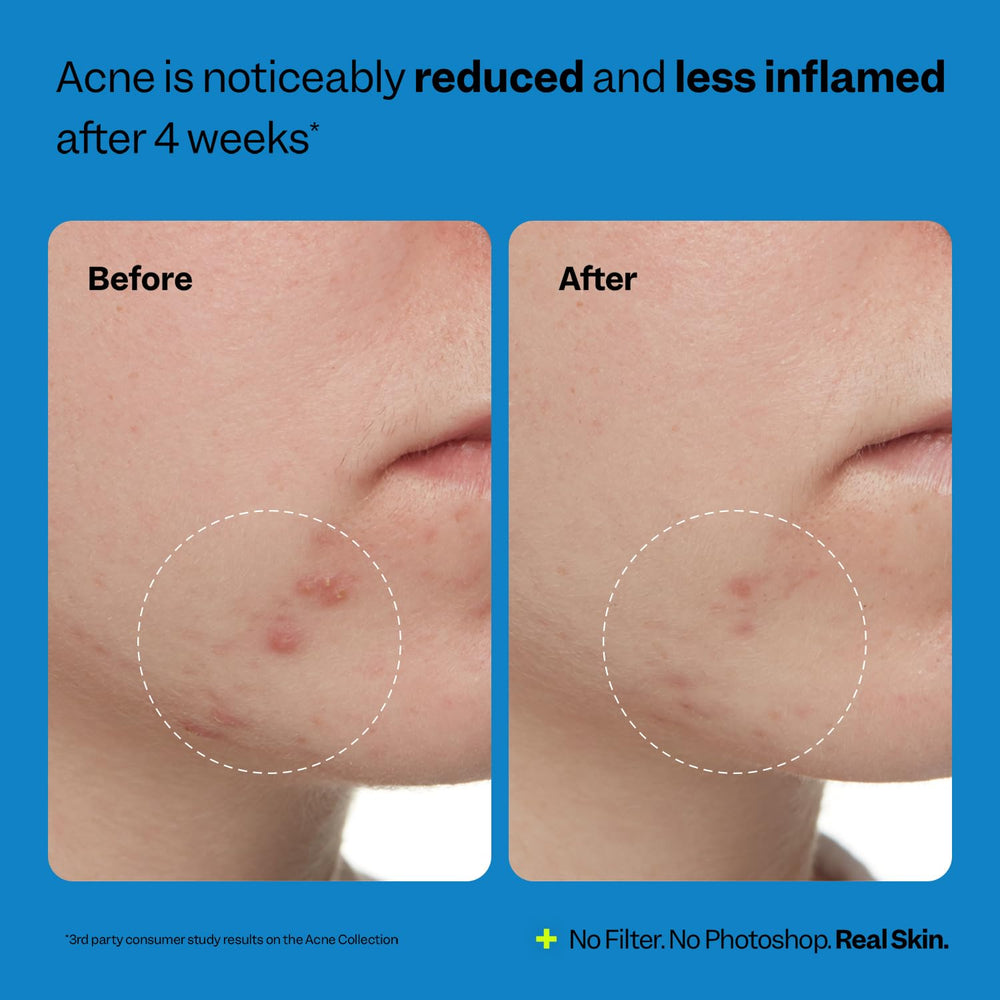 Peach Slices before-after shows potential improvements with consistent use.