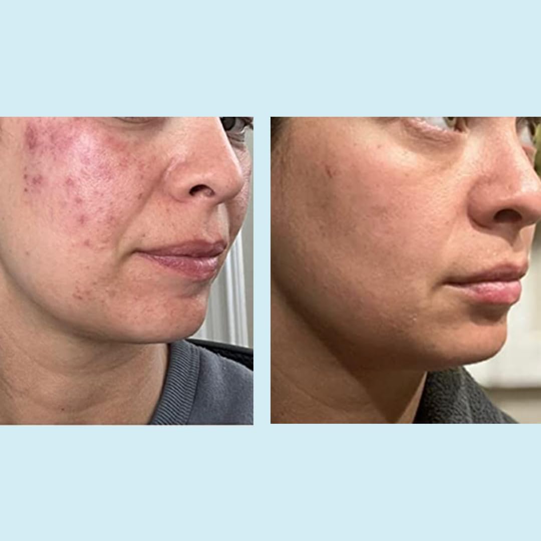 Perfect Image Glycolic 50% Gel Peel chamomile component adds soothing context.