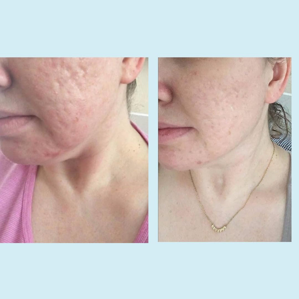 Perfect Image Glycolic 50% Gel Peel green tea extract scene emphasizes antioxidants.