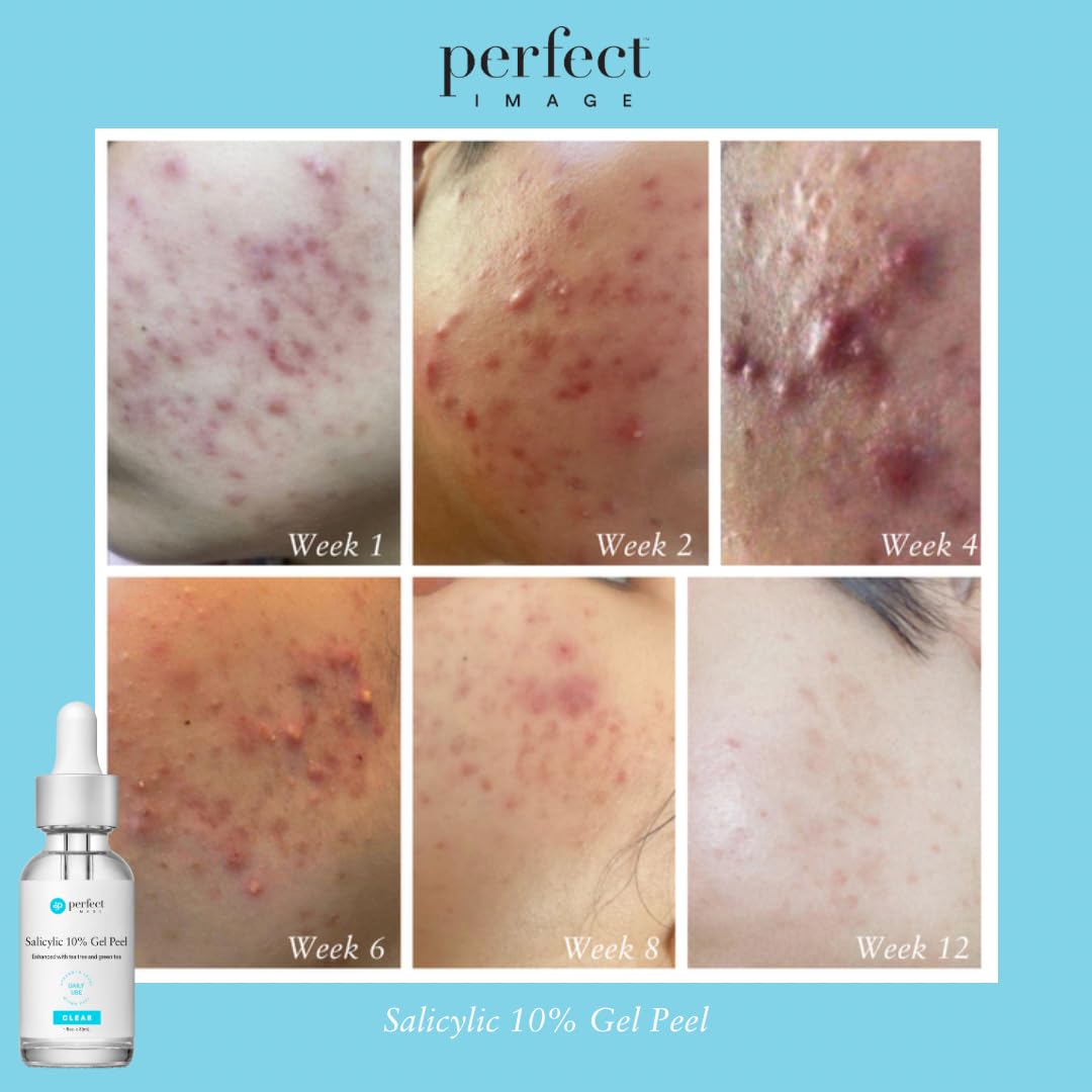 Perfect Image Salicylic 10% Gel Peel pore-clearing results for healthier skin.