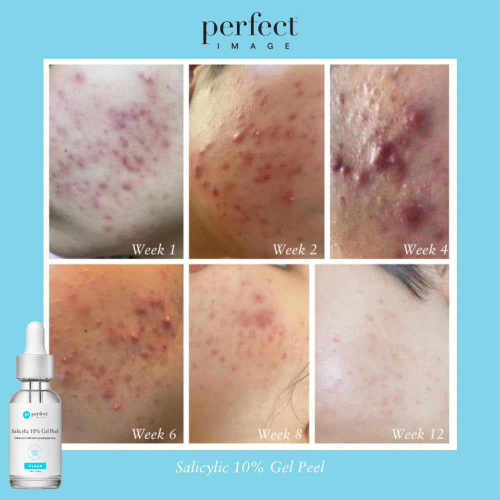 Perfect Image Salicylic 10% Gel Peel pore-clearing results for healthier skin.