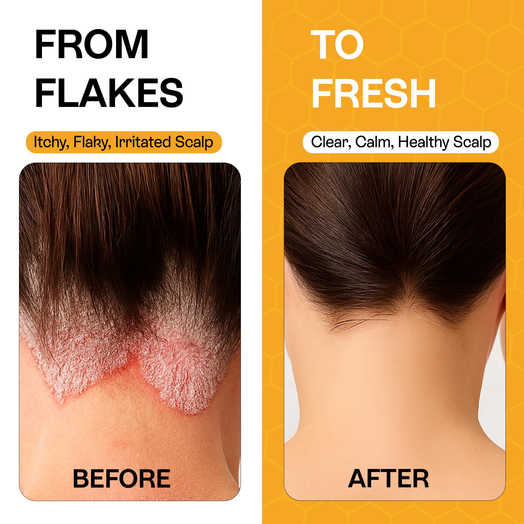 Pharmlitalia psoriasis shampoo foamy rinse showing refreshed, clean scalp and reduced itch
