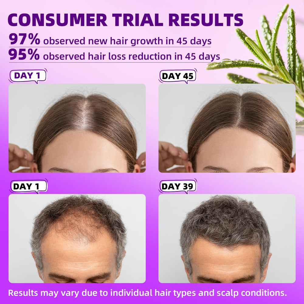 Pipuxi minoxidil spray application for easy daily scalp nourishment