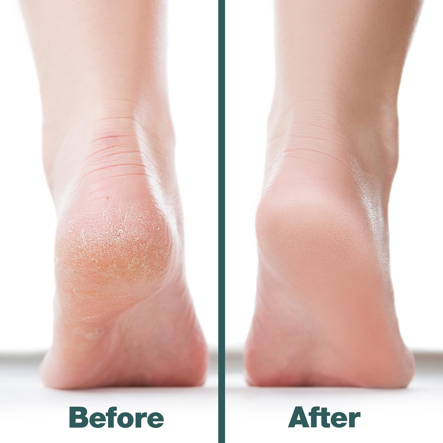 Probelle cracked-heel before-after demonstrates improvement with foot file