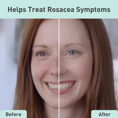 PROcure Rosacare Serum dispense pump demonstrates easy, hygienic application for daily rosacea care