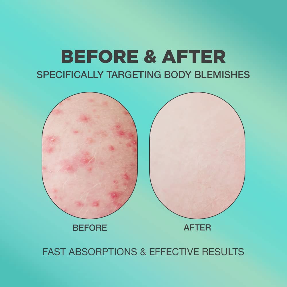 PROOT Butt Acne Cream texture close-up shows lightweight non-greasy formula