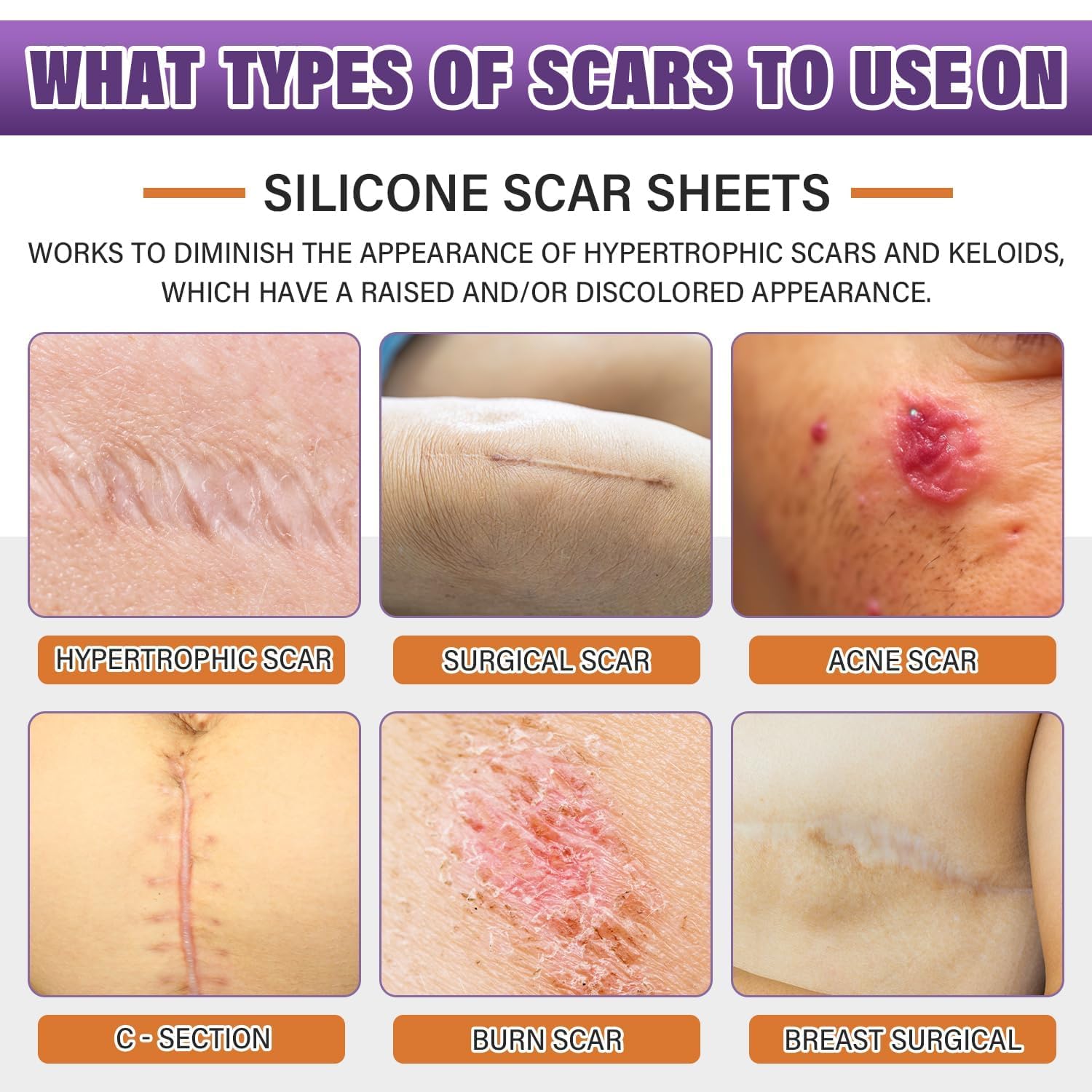 Psecici silicone scar sheets roll being cut to fit a scar