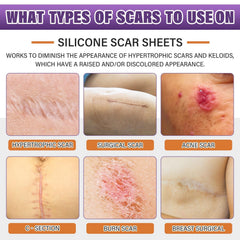 Psecici silicone scar sheets roll being cut to fit a scar
