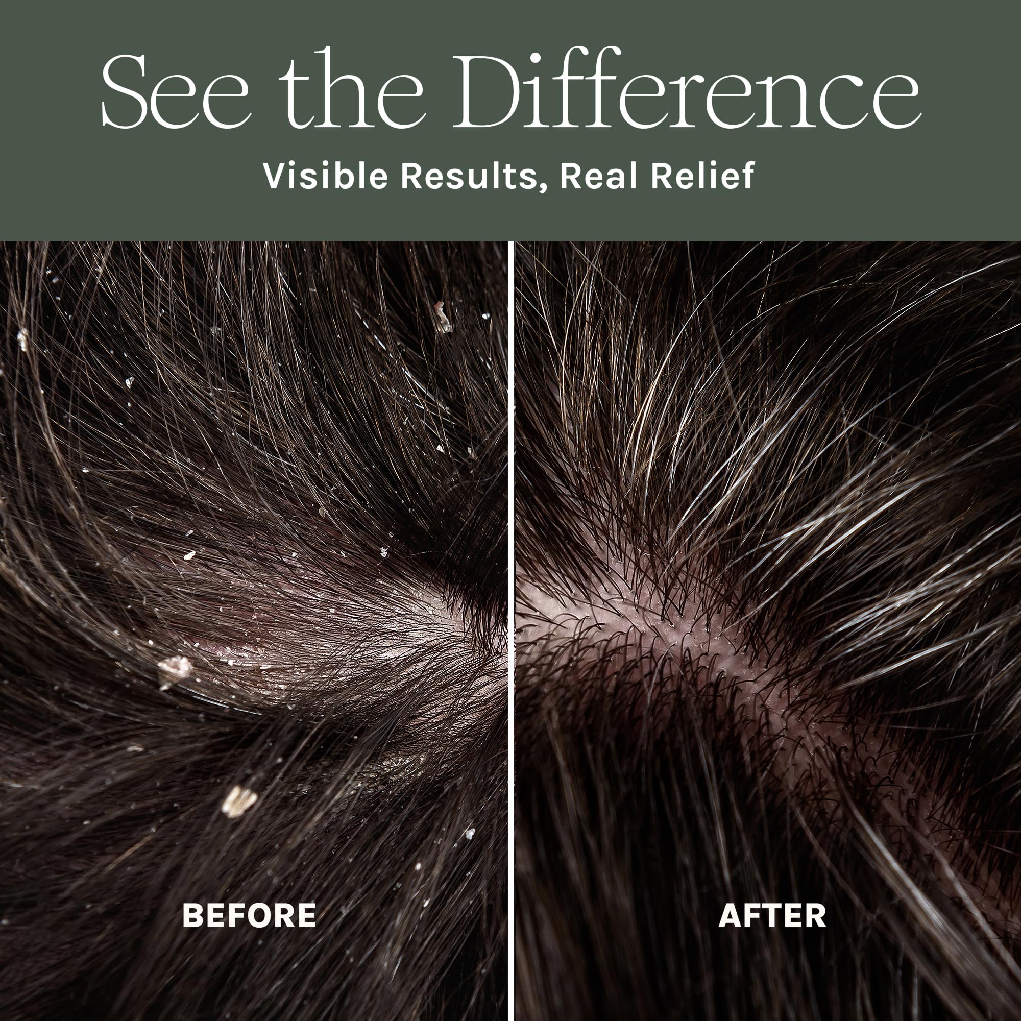 Purist Dandruff Spray scalp closeup highlights soothing, non-greasy hydration.
