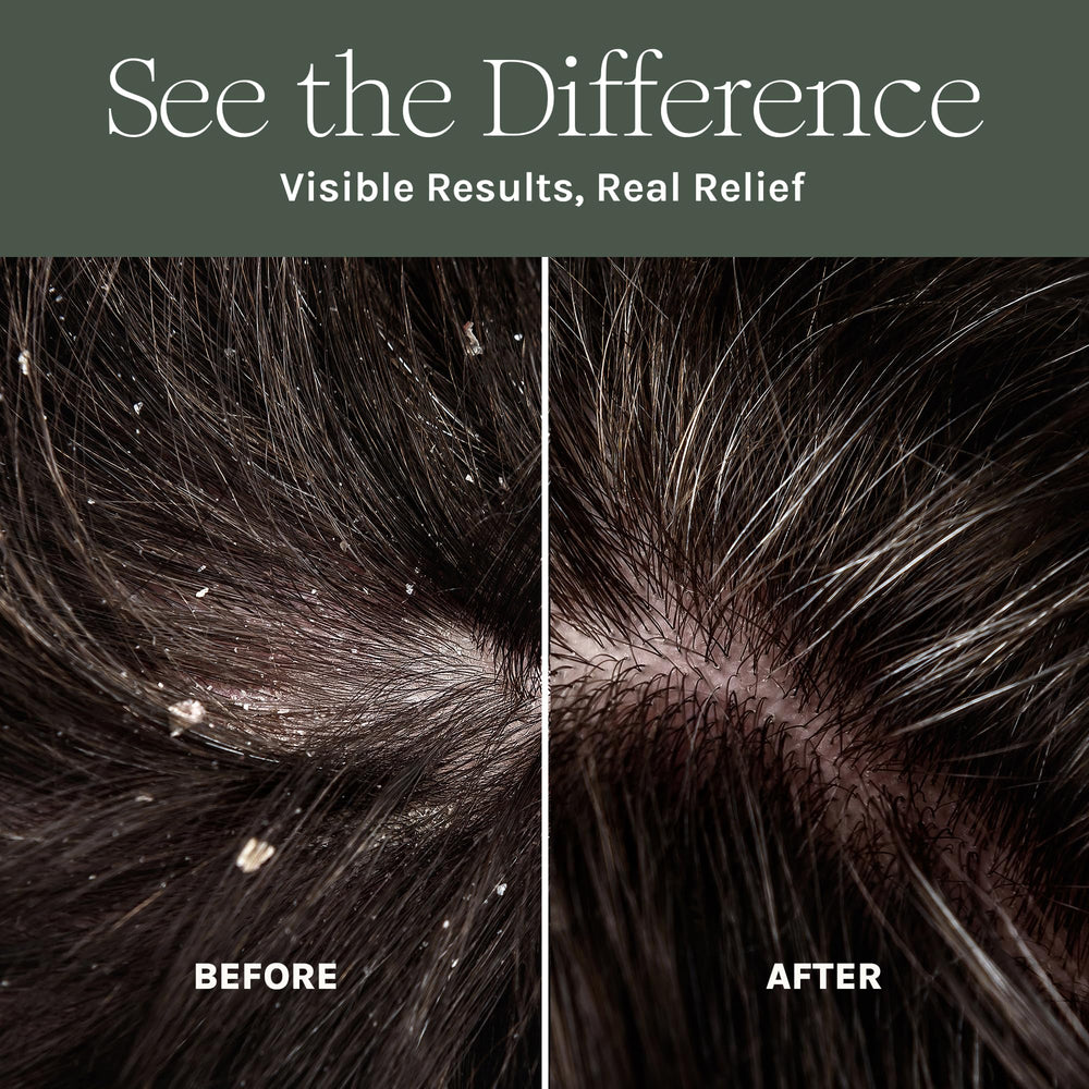 Purist Dandruff Spray scalp closeup highlights soothing, non-greasy hydration.