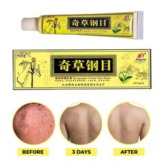 QICAOGANGMU Chinese Herbal Cream being applied to dry skin for relief